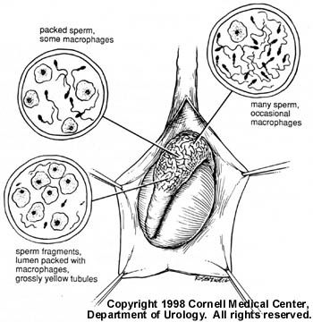 Fertility Preserving Hernia Repair