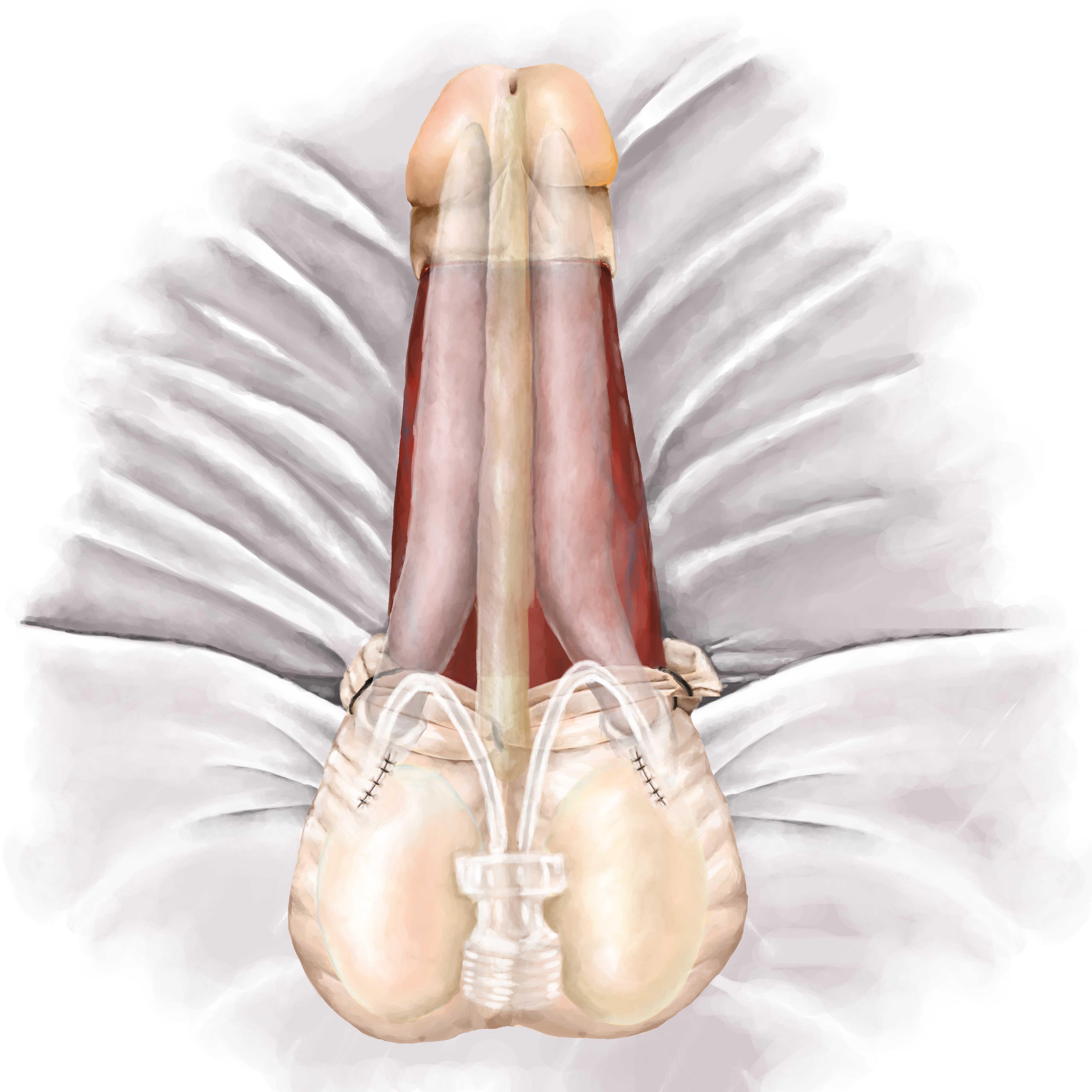 Prosthesis placement