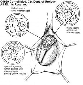 Obstructive vs. Non-Obstructive Azoospermia  Center for Male Reproductive  Medicine & Microsurgery