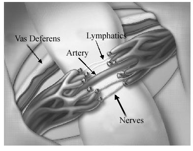 Surgical Varicoceles Treatments NYC Center for Male Reproductive